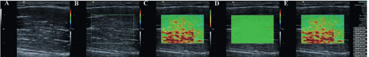 Fig  1.  The  transducer  was  placed  in  a  posi- posi-tion parallel to the muscle’s longitudinal plane,  where  the  muscle  tissue  could  fulfill  the  ROI  area (on the belly of the muscle in all cases),  so  that  the  more  valid  SWV  values  coul