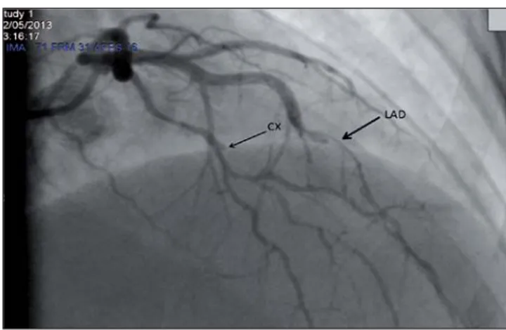 Fig. 2 – Coronary angiography showing ﬂ ow limiting spiral dissec- dissec-tion in LAD and non-ﬂ ow limiting discrete lesion in Cx artery in  right cranial view.