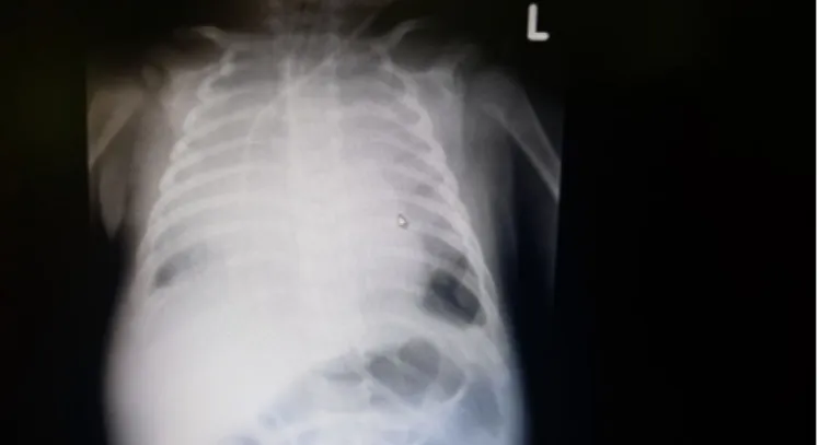 Figure 3. On the 10 th  day of hospitalization chest X-ray shows 