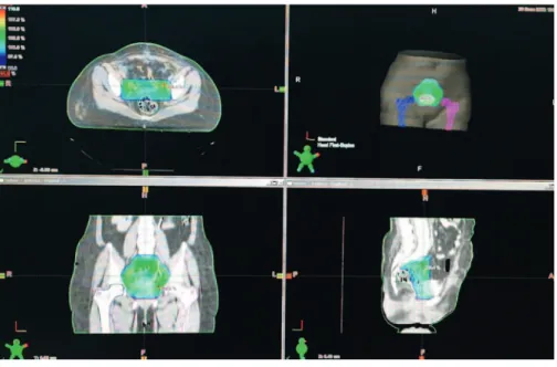 Fig. 1. Dose-color wash images of 3-dimentional  radiotherapy plan in a cervical cancer patient with  postoperative intermediate risk factors