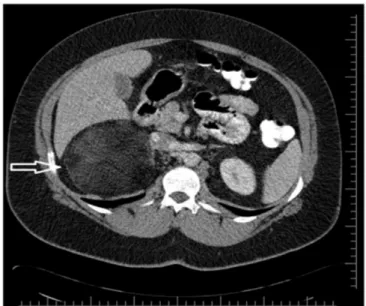 Figure 1. Conformal contour with heterogeneous mass in limited fat  densities in the right adrenal gland in computed tomography