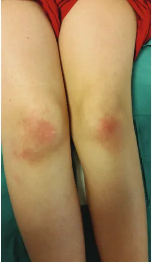 Figure 2. Erythematous papules on the back and a linear erythematous 