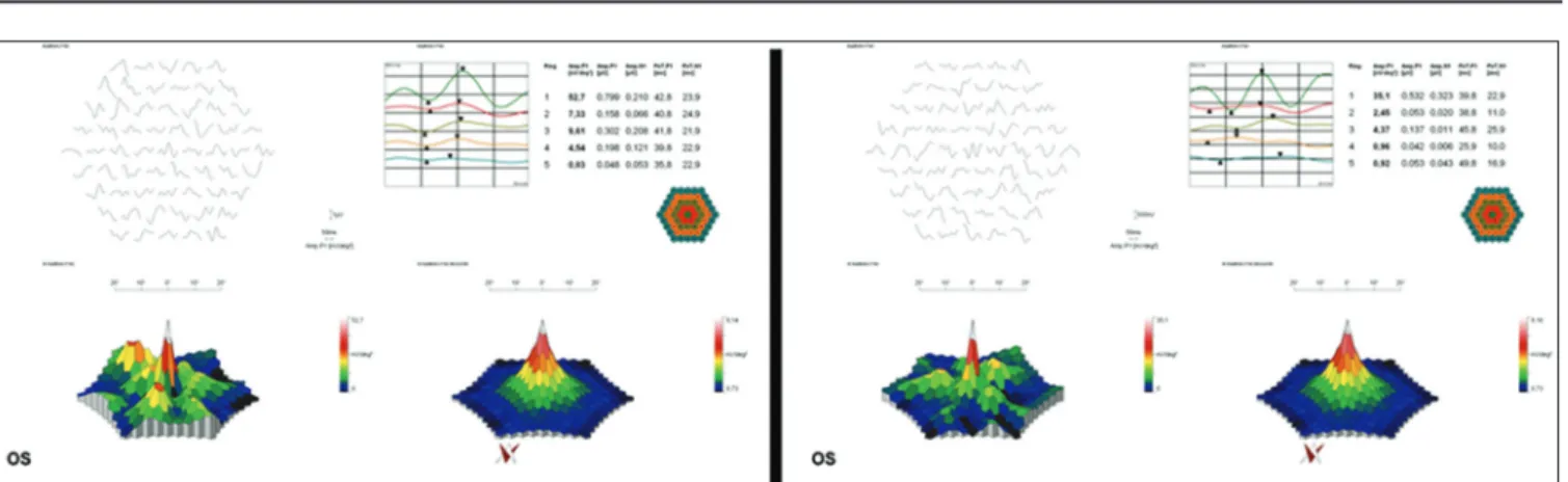Figure 1: Multifocal electroretinography of a patient before (left) and after (right) valproic acid treatment