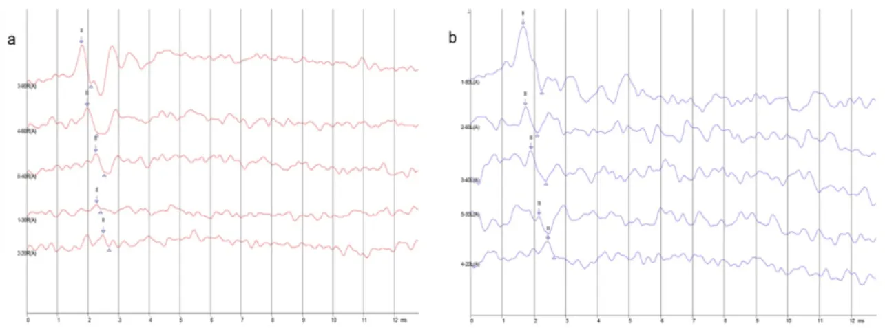 Şekil 3.2. ACTH grubundan bir rata ait 10 kHz frekansında ölçülmüş sağ (20 dB) ve sol (20  dB) ABR dalga örnekleri 