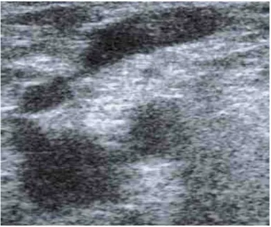 Şekil 2.8.  Vena safena magnaya paralel s varyasyonu gösteren bir dalın US görüntüsü. 