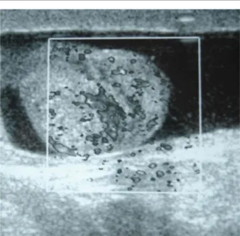 Figure 1. Color Doppler Ultrasonography Image Shows Increased Vascu-