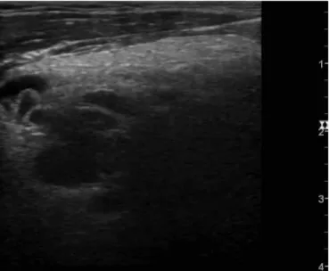FIG. 1. Ultrasonography  of  the  heterogeneous  right  lobe  of  the 