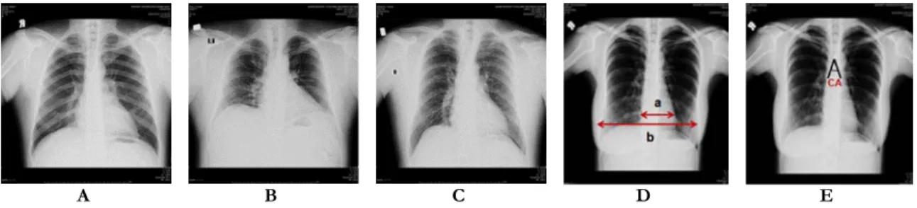 Figure 1. The lobulation (A), eventration (B) and contour (not smooth) (C) of diaphragm were shown with  arrows