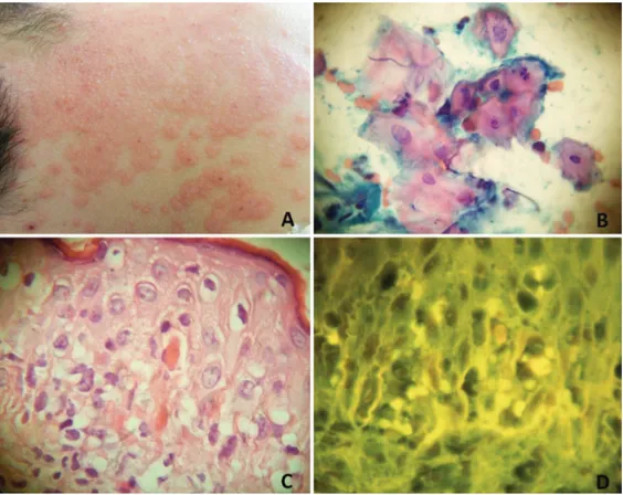 Figure 1.  Clinical, cytological, histopathological, and immunofluorescence microscopic  findings of a case with erythema multiforme