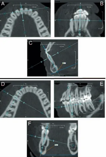 Figure 3. Consecutive cross-sectional (A,B,C) and axial (D) slices indicating dehiscence presence on the buccal surface of the right maxillary canine.