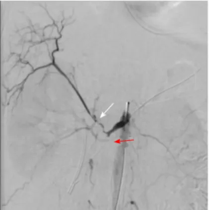 Figure 3 Conventional angiography of superior mesenteric artery after  stent placement