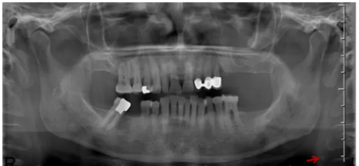 Fig. 2 – Image of a digital panoramic radiograph (DPR) show- show-ing a unilateral radiopacity of suspected carotid calcification on the right side (arrow).