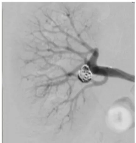 Figure 1. Renal artery aneurysm  Figure 2. Aneurysm was embolized with coils 