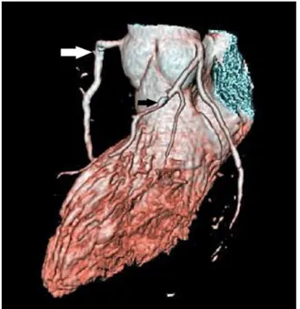Figure 1 right coronary artery with plaque (white arrow) and left anterior desce-