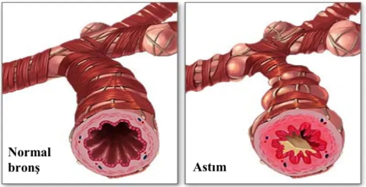 Şekil 2.1. Normal ve astımlı bireyde bronşun görünümü. 