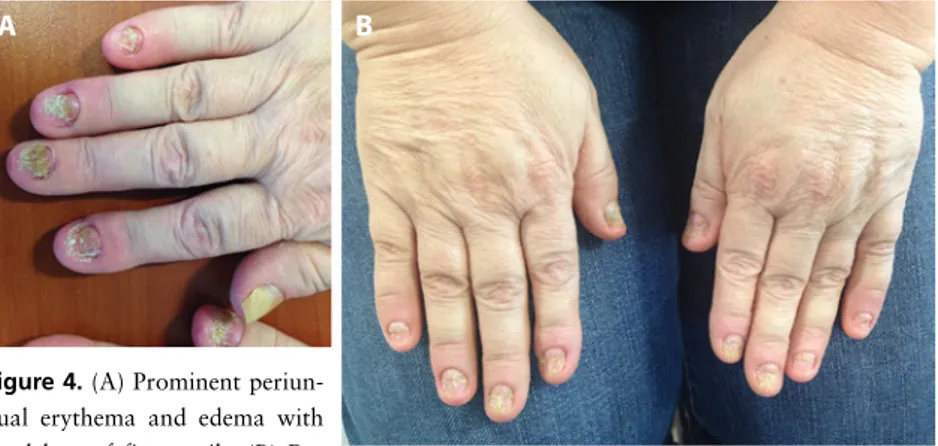 Figure 2. (A) Proximal shedding in some 