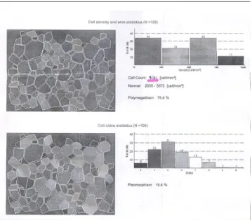 Fig 2. Decreased endothelial cell density with high polymegathism