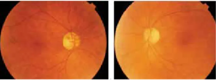 Figure 1. Fundus photograph of the right eye showing a cup-to-disc ratio of 0.7 