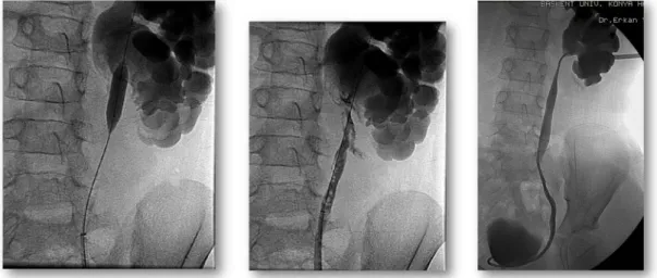 Figure 2 a-c. Retrograde cutting balloon dilatation in 7 years old boy a) cutting balloon dilatation of stenosis, b) control 
