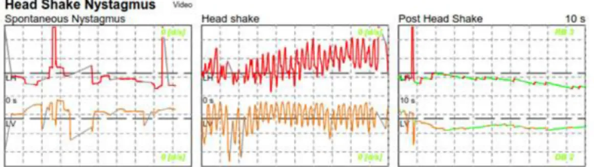 Şekil 12 Post head shake nistagmus (63) 