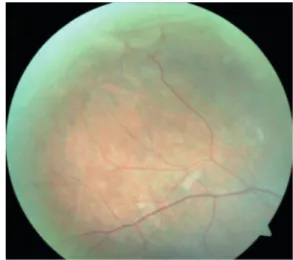 Figure 7. Optical cohorence tomography image of left eye after scleral buckling, 