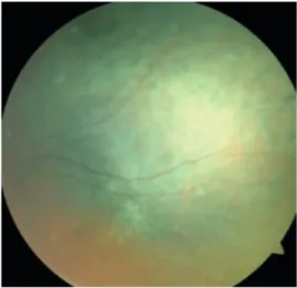 Figure 12. Optical cohorence tomography image of left eye 36 months after 