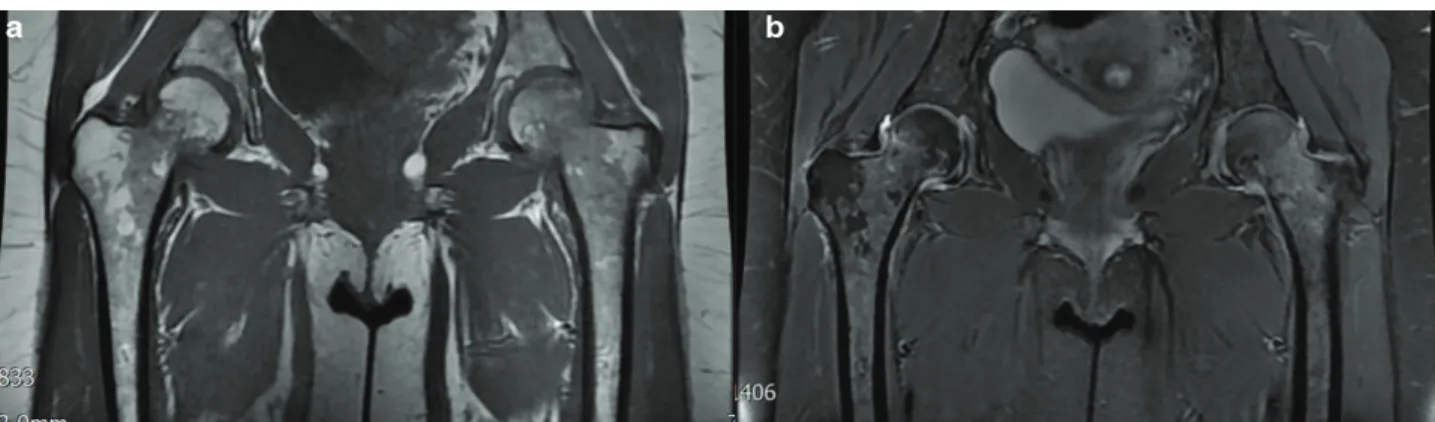 Figure 1. Coronal T1 fat spin echo (a) and proton density fat saturation imaging (b) showing widespread bone marrow edema from the level of 