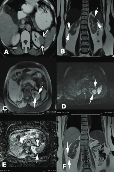 Fig. 2. Histopathological sections of left renal leiomyoma. A Neoplastic 