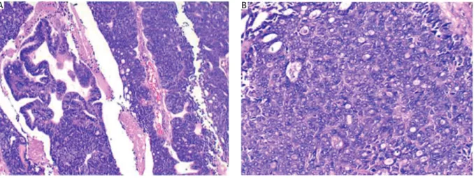Fig. 2. Histopathological image of left ovary. Serous adenocarcinoma (H&amp;E ×10 original magnification and inset ×20 original  magnification)