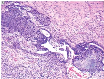 Fig. 3. Histopathological image of right ovary. Epithelial ade- ade-nocarcinoma component, rhabdomyosarcomatous and  chon-drosarcomatous heterologous elements of malignant mixed  Müllerian tumours (H&amp;E ×10 original magnification)