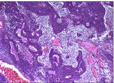 figure 2: surgical specimen shows the mass in the left lung  superior lobe.