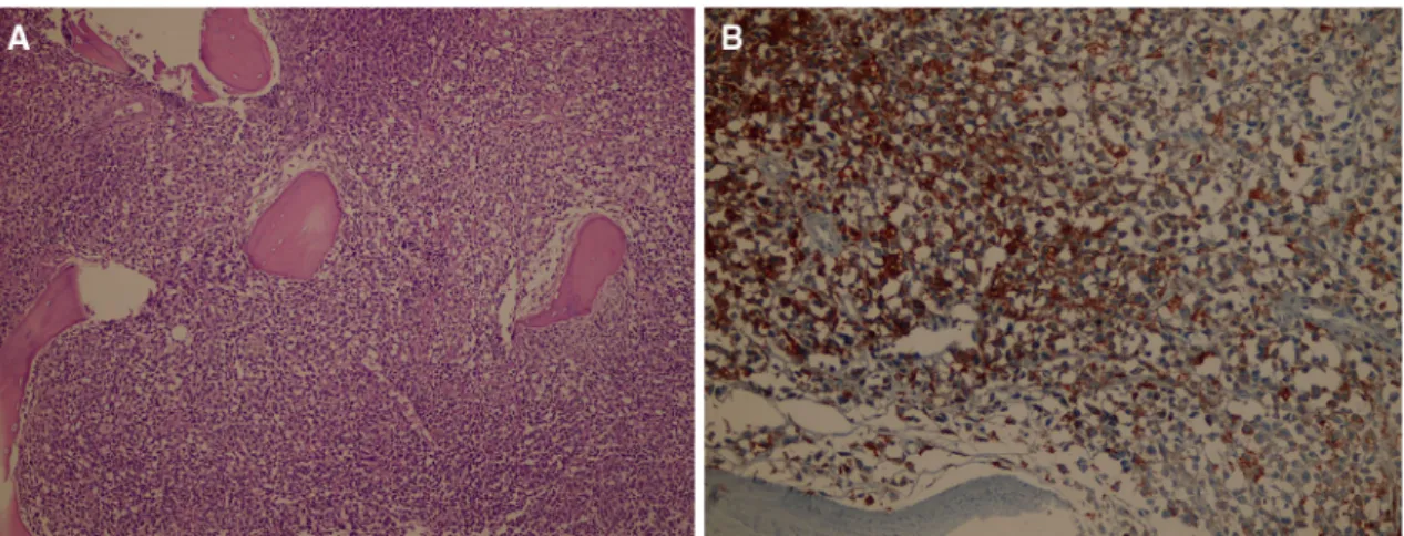 Fig. 4 Cutaneous lesions in Case 3. a Slightly indurated, erythem- erythem-atous–violaceous plaque on the scalp; b multiple erythematous patches and indurated plaques on the trunk; c conjunctival hematoma located on the temporal side; d violeceous plaque l