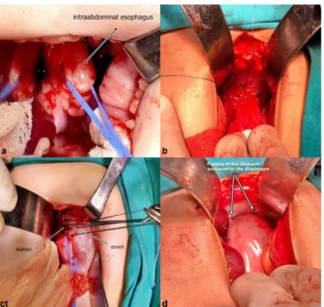 Fig. 1 Intraoperative pictures showing of the procedure. a Mobilization of intra-abdominal esophagus