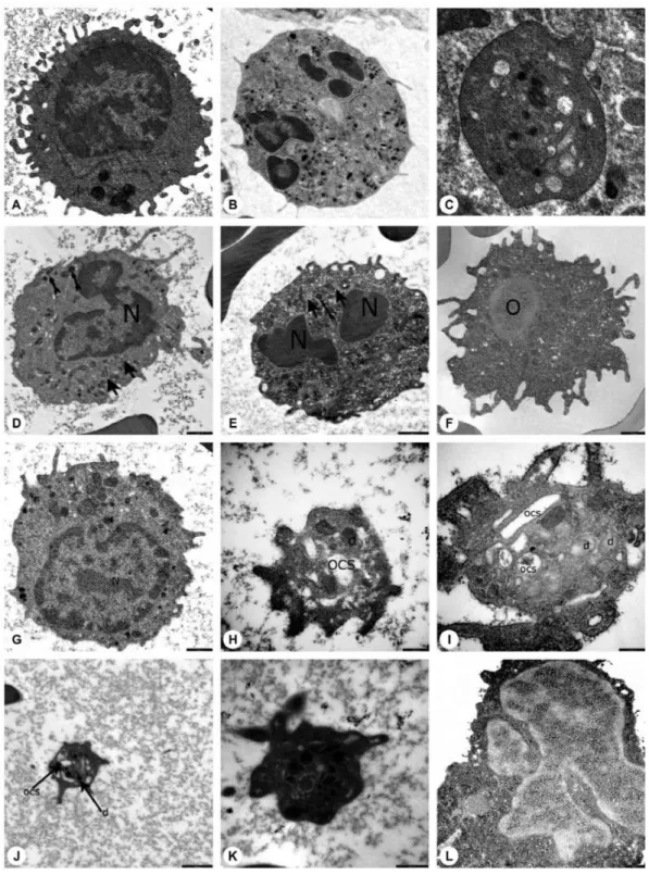 Figure 4. Electron microscopic images of the blood cells of the patients. A) Normal lymphocyte (16700 x ), B) normal neutrophil (3597 x ), C)  normal thrombocyte (10000 x ), D) patient EC (with HAX1 mutation) (12930 x ), E) patient NBÖ (with ELANE mutation
