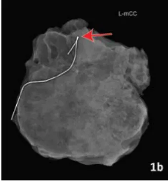Figure 1b. a Specimen radiography demonstrated  the lesion was excised fort he left defined lesion (red  arrow)
