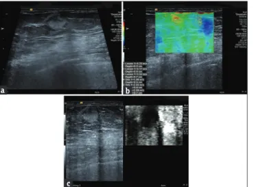 Figure 1: 57 year’s old female with a diagnosis of peripheral T‑cell 