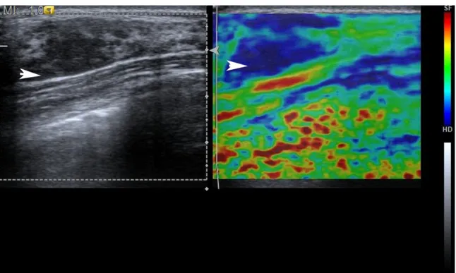 Figure 1. Bmode US image shows solid hypoechoic lesion with indistinct margings on the right