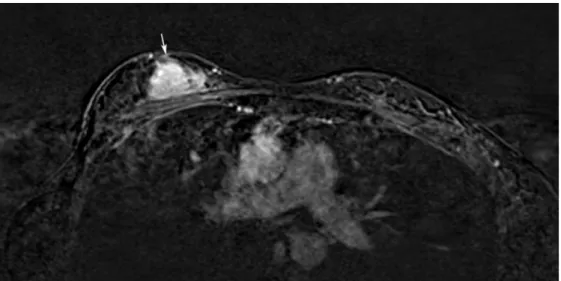 Figure 4. Dynamic contrast enhanced T1 weighted MR images show solid enhancing lesion in the right breast (arrow)