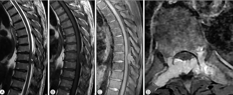 Fig. 2. AP (A) and lateral (B) X-Ray images demonstrate a short segment  spinal instrumentation and fusion with transpedicular screws and rods  at the level of T8–10