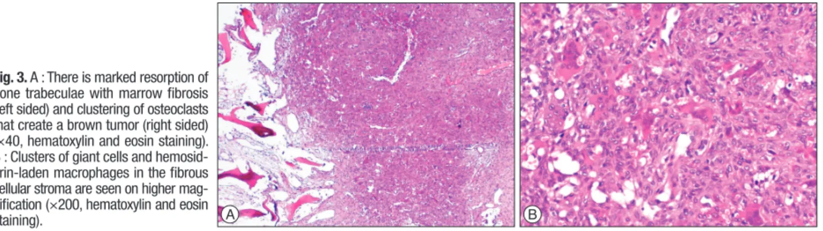 Table 1. Literature review of spinal Brown tumors seen in primary hyperparathyroidism