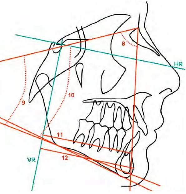 Şekil 3.13. Araştırmada kullanılan mandibuler iskeletsel ölçümler 