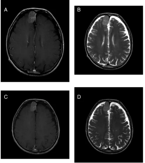 Fig. 1. 69 year old male patient with frontal meningioma who underwent 6 enhanced brain MRIs with linear GBCA