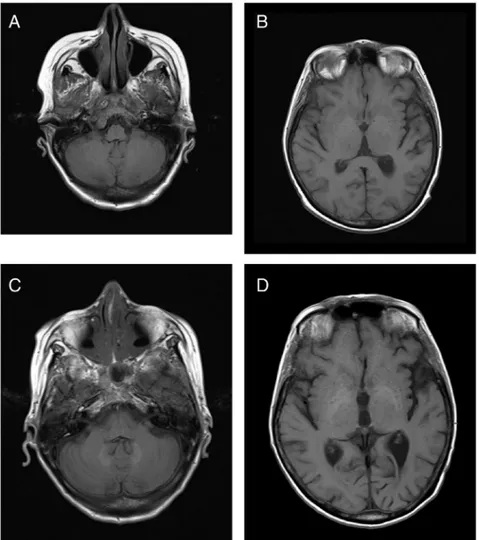 Fig. 5. Axial pre-contrast T1 weighted images showing the typical ﬁnding of hyperintensities in DN and GP