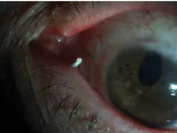 Figure 2. A patient with canaliculitis due to an eyelash entering the left inferior  canaliculus