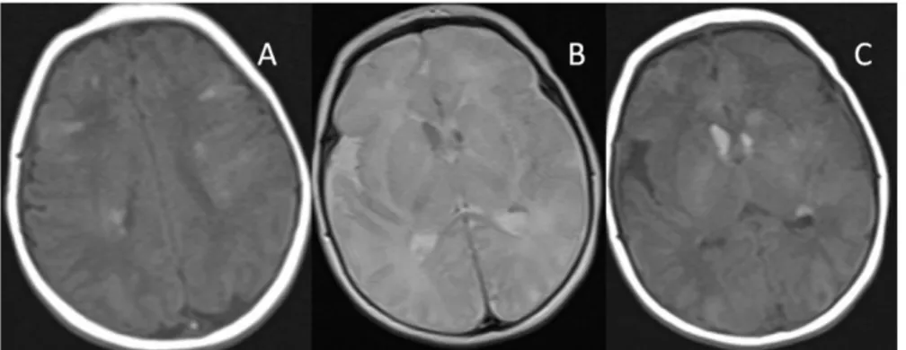 Şekil 3: A’ da T1 ağırlıklı aksiyel beyin magnetik rezonans görüntüde tüberoskleroz kompleksine bağlı  tuberler, B’ de T2 ağırlıklı ve C’ de T1 ağırlıklı aksiyel beyin magnetik rezonans görüntülerde tüberoskleroz  kompleksine bağlı subepandimal nodüller iz
