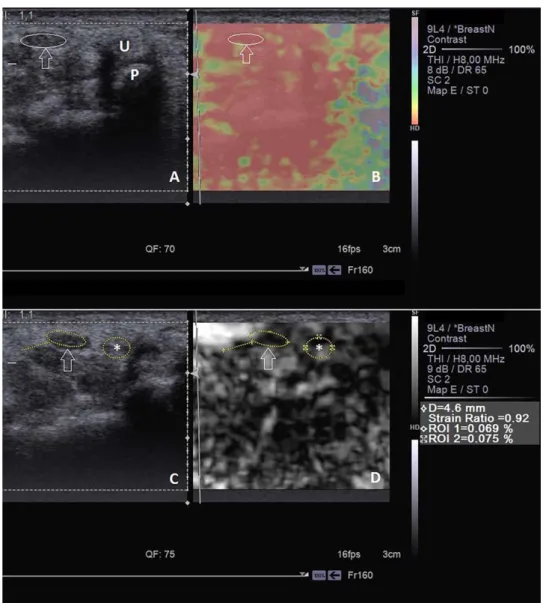 Figure 1. Images from a 55-year old woman with untreated mild CTS. A, Conventional B-mode image shows the median nerve (white oval with arrow), ulnar artery (U) and pisiform (P)
