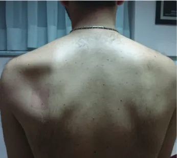 Figure 2 (a-b). Diffuse edema and atrophy of the supraspinatus 