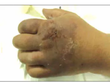 Figure 1. Patient’s hand prior to fasciotomy. Note the demar- demar-cation line