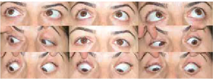 Şekil 1. Hastanın ilk muayenesinde altıncı sinir paralizisine bağlı sol göz dışa 