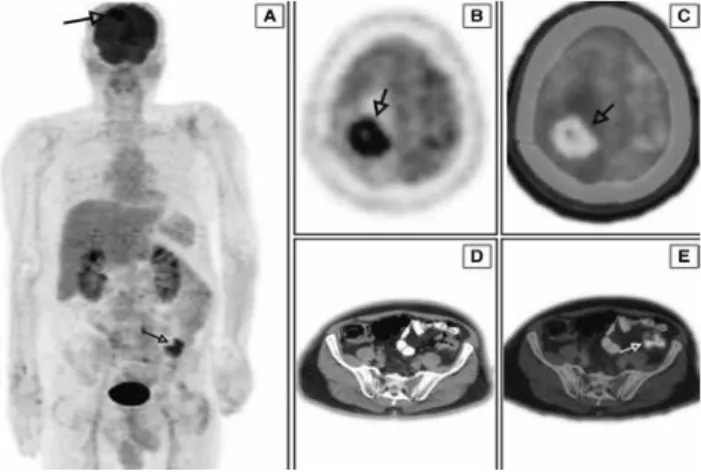 Figure 1. Maximum intensity projection (A), axial PET (B), fusion (C), 